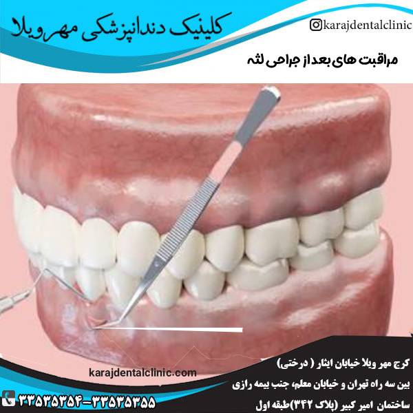 مراقبت های بعد از جراحی لثه