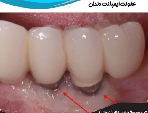 عفونت ایمپلنت دندان | آیا عفونت بعد از ایمپلنت طبیعی است ؟