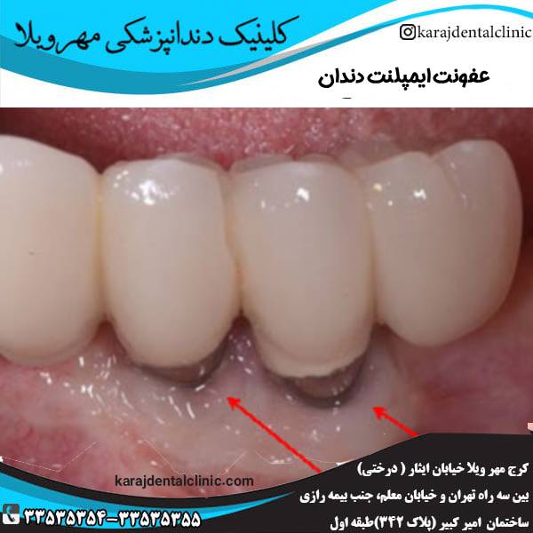 عفونت ایمپلنت دندان