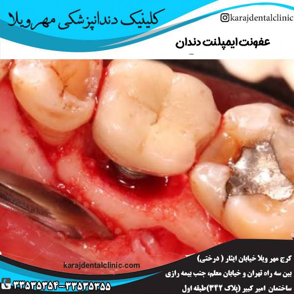 عفونت ایمپلنت دندان