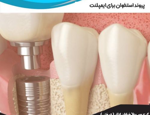 مزایا پیوند استخوان برای کاشت ایمپلنت | نحوه و عوارض کاشت استخوان