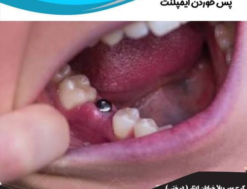 علائم پس خوردن ایمپلنت دندان | نحوه درمان