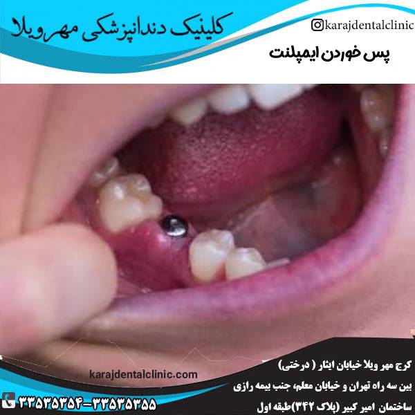 پس خوردن ایمپلنت دندان