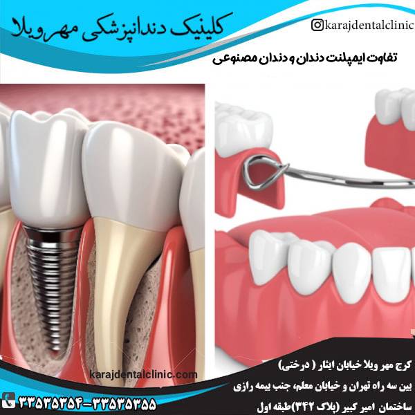 مقایسه ایمپلنت و دندان مصنوعی