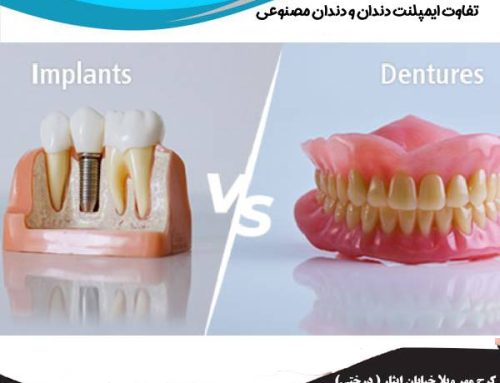 ایمپلنت بهتر است یا دندان مصنوعی؟ بهترین روش کدام است؟