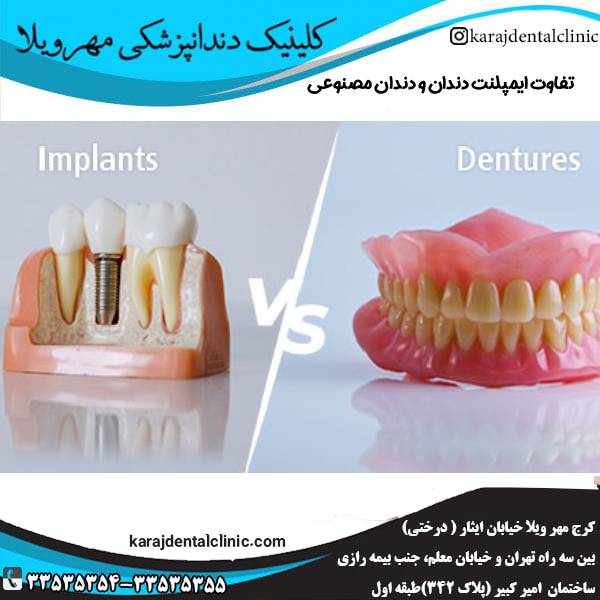 مقایسه ایمپلنت و دندان مصنوعی