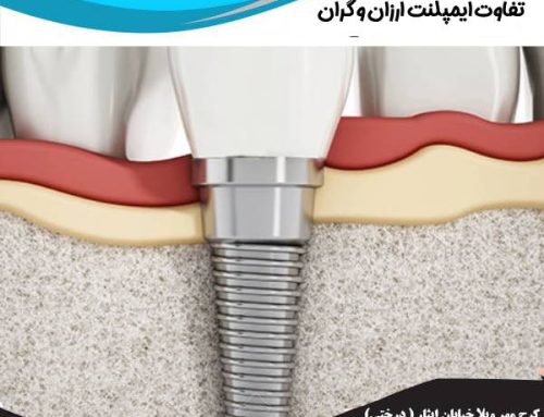 تفاوت ایمپلنت ارزان و گران  | ایمپلنت ارزان بهتر است یا گران؟