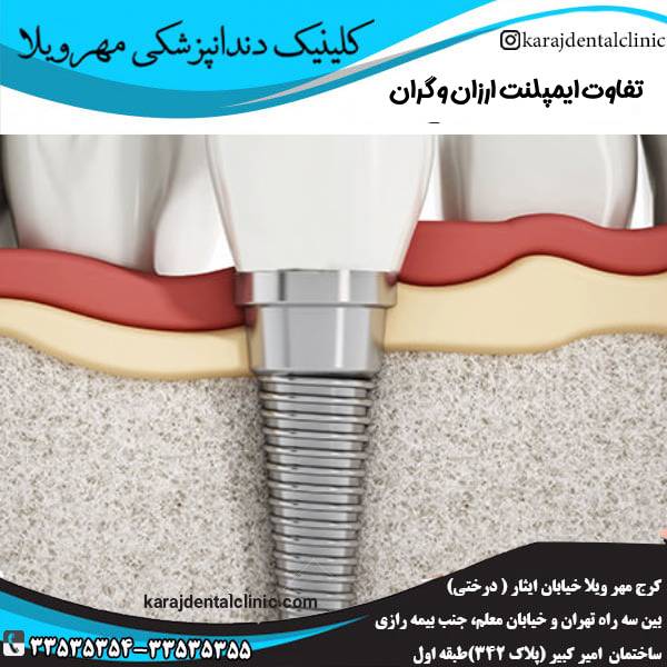 تفاوت ایمپلنت ارزان و گران
