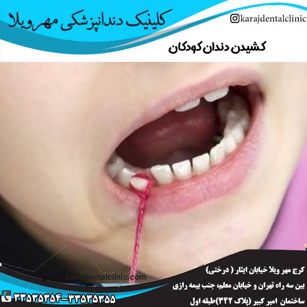 کشیدن دندان شیری کودکان