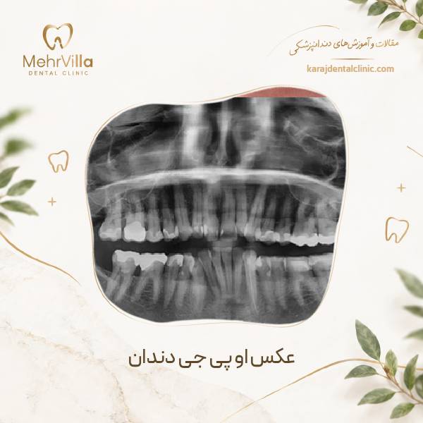 عکس او پی جی دندان