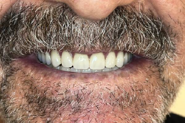 نمونه درمان اوردنچر متکی بر دو ایمپلنت در کلینیک دندانپزشکی مهرویلا