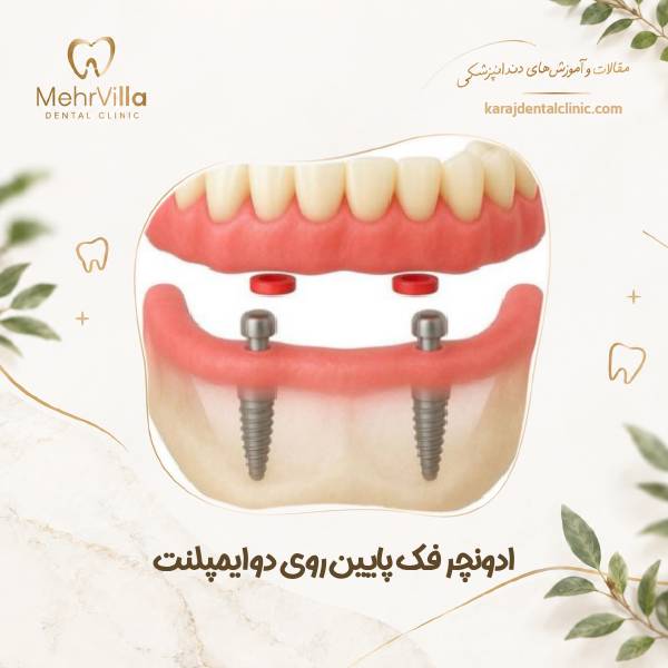ادونچر فک پایین روی دو ایمپلنت