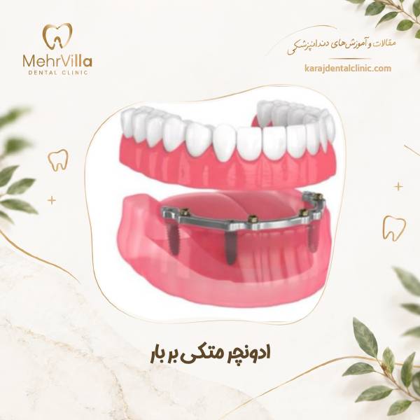 ادونچر متکی بر بار