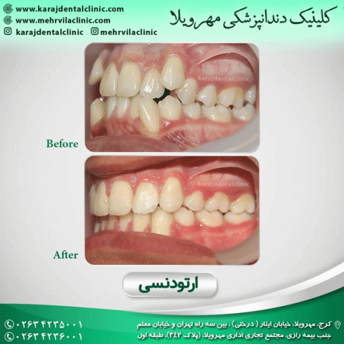 ارتودنسی-دندان-26