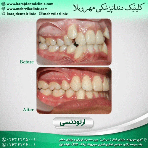 ارتودنسی-دندان-27