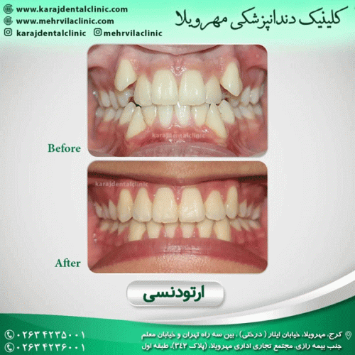 ارتودنسی-دندان-28