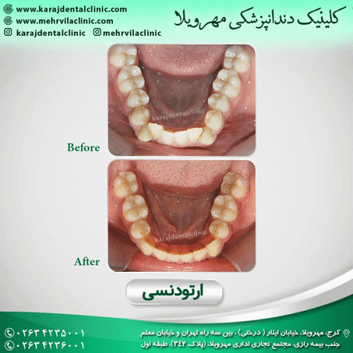 ارتودنسی-دندان-29