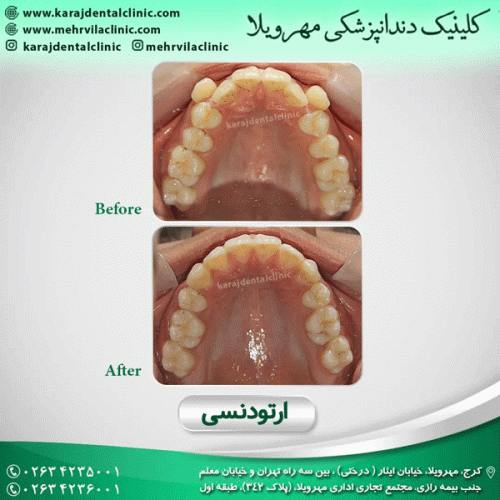 ارتودنسی-دندان-30