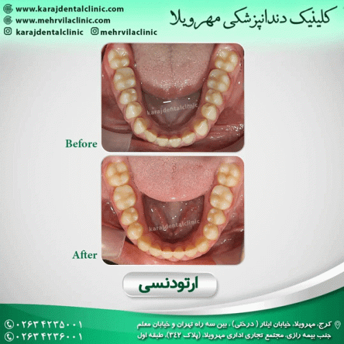 ارتودنسی-دندان-31