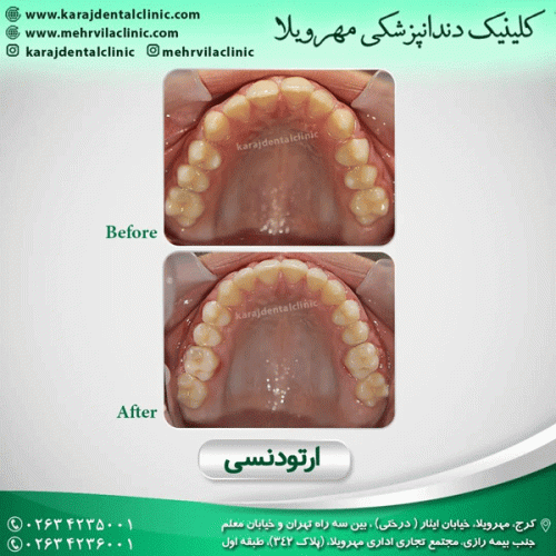 ارتودنسی-دندان-32
