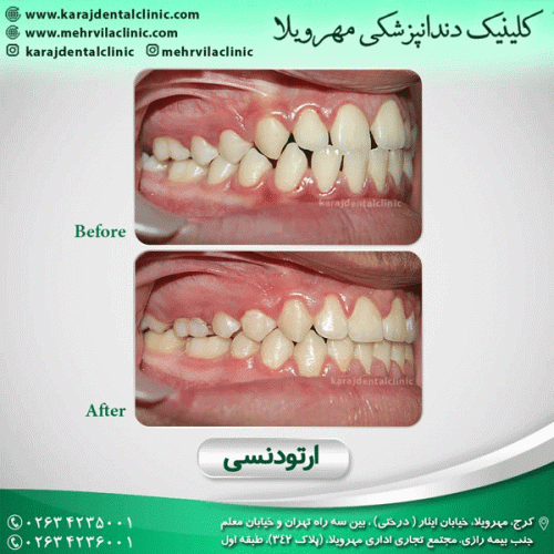 ارتودنسی-دندان-33