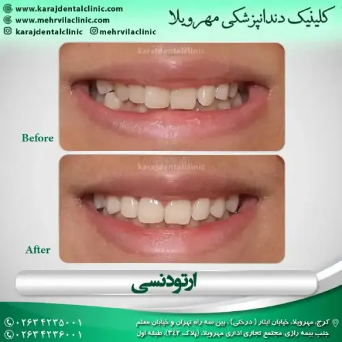 ارتودنسی-دندان-41