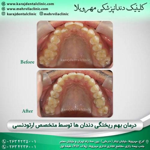 ارتودنسی دندان 16