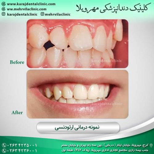 ارتودنسی دندان 5
