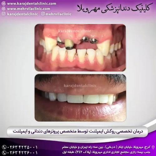 ایمپلنت دندان 10