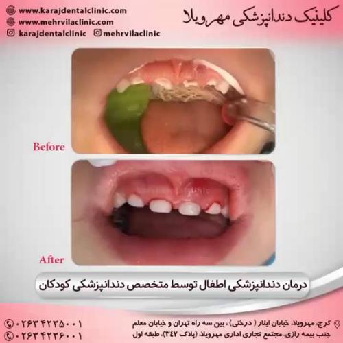 دندانپزشکی کودکان 22