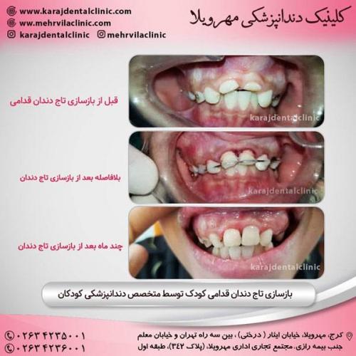 دندانپزشکی کودکان 4