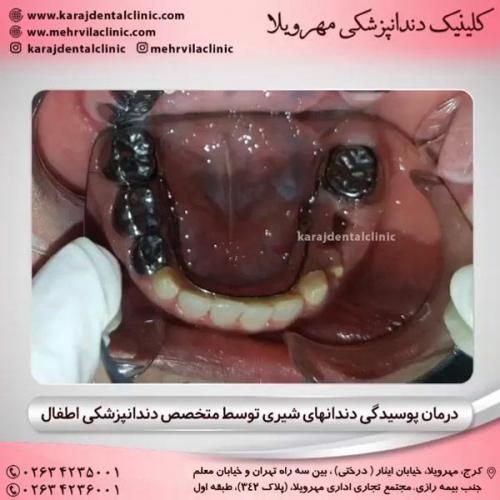 دندانپزشکی کودکان 8