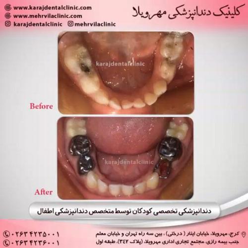 دندانپزشکی کودکان 9