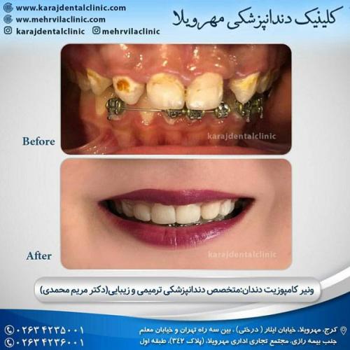 کامپوزیت-ونیر-دندان-4